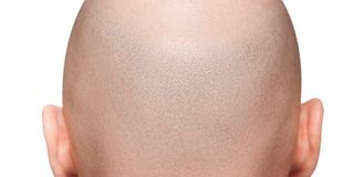 Male pattern baldness is a hair loss condition that can be treated using Rogaine or Propecia.