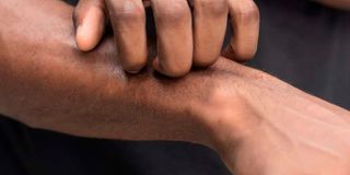 Scratching your skin will spread the rash and cause more discomfort.