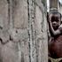 severe wasting, malnutrition, hunger, drought
